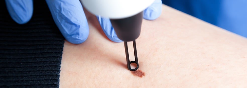 trattamenti laser lecco